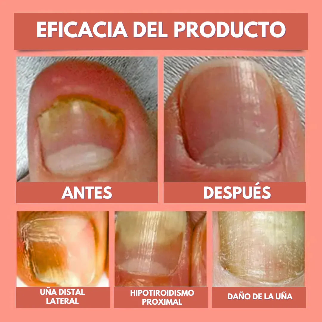 DermaPatch™ Parche Antifúngico para Hongo